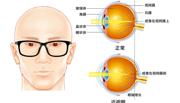 儿童视力保护新视角：蔡司小乐圆科学配镜，守护孩子的明亮未来